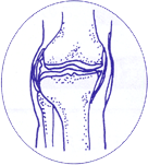 初期変形性膝関節症