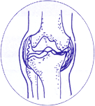 進行期変形性膝関節症